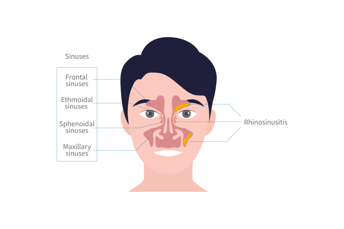 Chronic Rhinosinusitis 