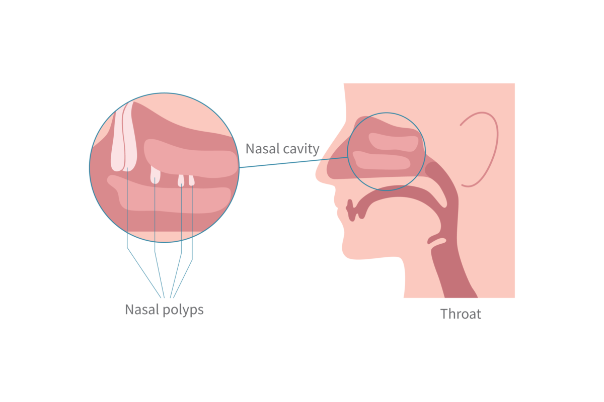 Chronic Rhinosinusitis Nasal polyps